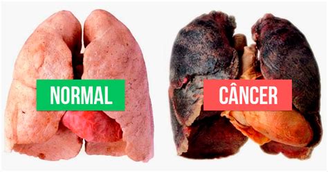 The sign and symptoms of a nonfunctioning tumor depend on the tumor location and size as well as on the presence of metastases. Câncer de pulmão - Tua Saúde