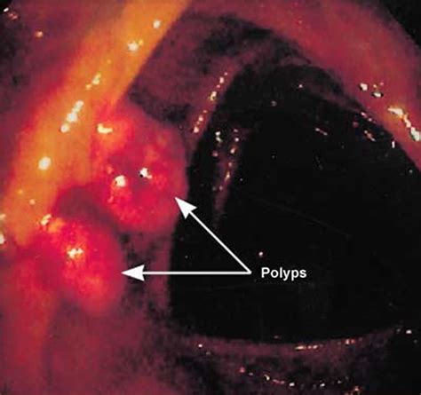 Cancer often has no specific symptoms, so it is important that people limit their risk factors and undergo appropriate cancer screening. Rectal Bleeding and Bleeding from the Rectum - Causes and ...
