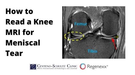 How To Read A Knee Mri For Meniscal Tear Centeno Schultz Clinic My