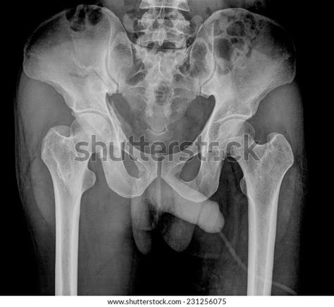 Surgical pelvic anatomy in gynecologic oncology. Xray Image Pelvis Hip Man Stock Photo (Edit Now) 231256075