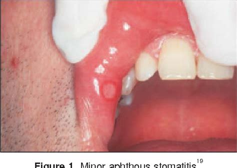 Figure 1 From Recurrent Aphthous Stomatitis Caused By Food Allergy Semantic Scholar