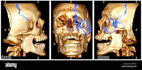 3d Ct Scan Image Of A Skull Fracture Stock Photo Alamy