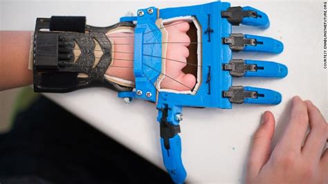 Why 3 D Prosthetics Are The Future Opinion