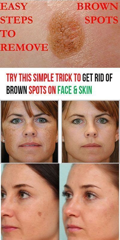 Try This Simple Trick To Get Rid Of Brown Spots On Face And Skin