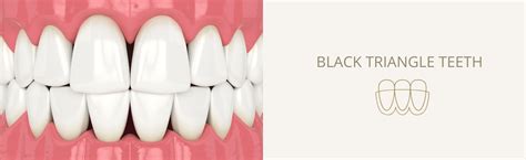 Black Triangle Teeth St Helens Dentist Kiln Lane Dental