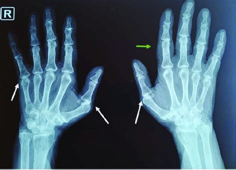X Ray Shows Ulnar Deviation Of Both Hands Subluxations Of The 1st And
