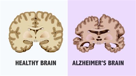 What Are The Stages Of Alzheimer And Their Effects Circlecare