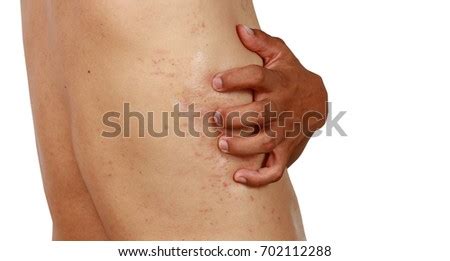 Tempting as it is, one of the worst things you can do to an itch is to scratch it. "heat Rash" Stock Images, Royalty-Free Images & Vectors ...