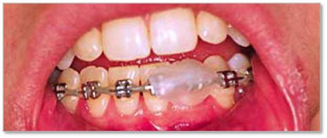 Orthodontic braces wax is commonly made from paraffin, beeswax, or carnauba wax, which are all analgesic substances that naturally promote the warmth will allow the wax to apply seamlessly. Emergency Orthodonitc Care
