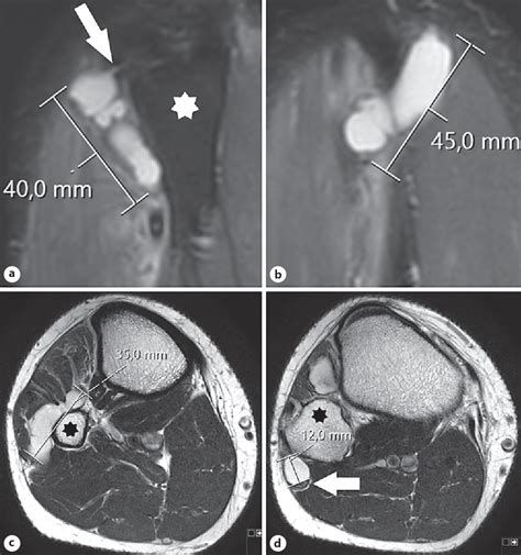 Figure 1 From Large Intraneural Ganglion Cyst In The Peroneal Nerve