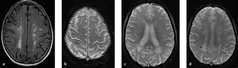 9 Small Vessel Disease Radiology Key