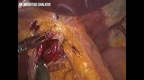 Lap Bilateral Truncal Vagotomy Crural Repair With Posterior