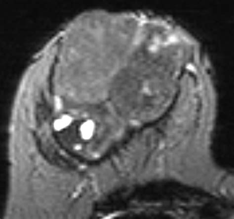 Differentiation Of Phyllodes Breast Tumors From Fibroadenomas On Mri Ajr