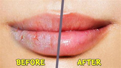 Cracked Lips Are Ugly In Winter Check These Tips Telugu Fashion Tips
