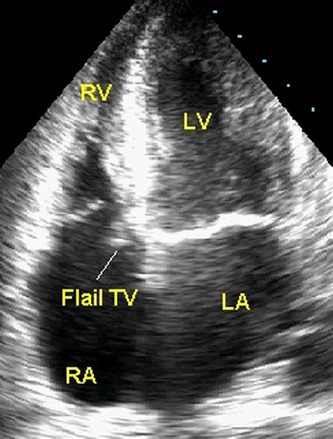 Vegetation On Tricuspid Valve Echocardiographic Image All About