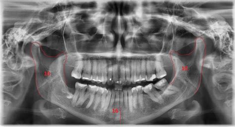 Radiografía Panorámica ¿qué Es La Ortopantomografía Hr