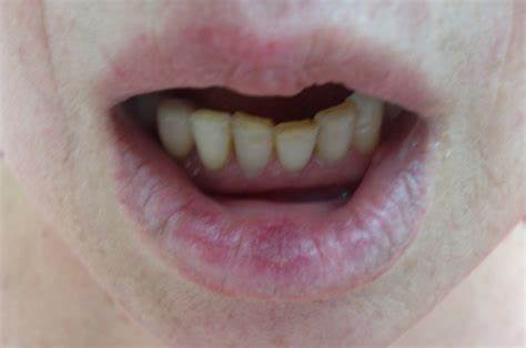 Диета при дискоидной красной волчанки Диета при дискоидной красной волчанки