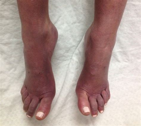 Purple Feet 7 Medical Reasons You Should Look Out For