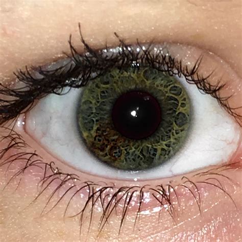 I Have A Small Amount Of Sectoral Heterochromia In My Right Eye Plus A