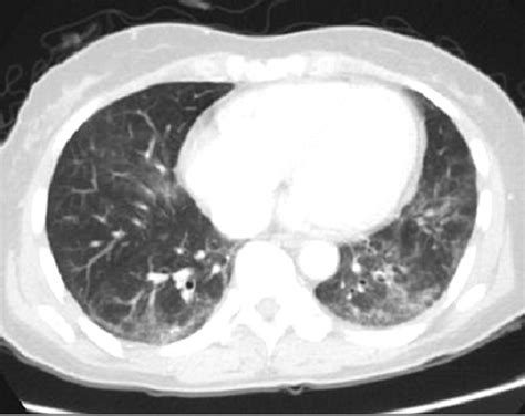 Chest Computed Tomography Shows Ground Glass Opacity And Reticular