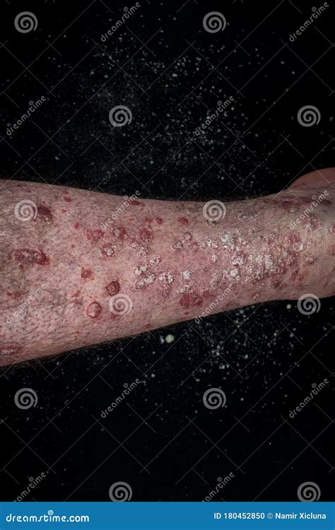 Psoriasis Eczema On The Foot Man Itching Skin Psoriasis Scales Are