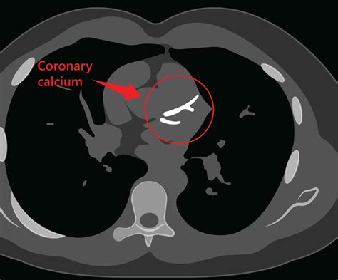 Coronary Calcium Score Capital Heart Centre