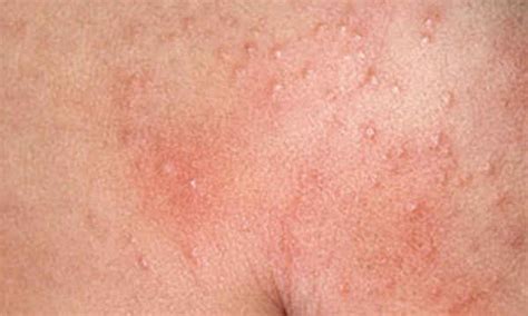 Maculopapular Rashes Causes With Pictures