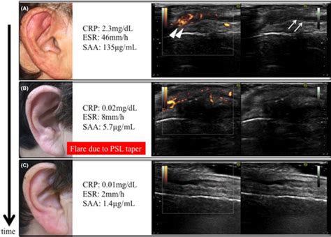 Ultrasonography Of Auricular Cartilage Is A Potential Tool For