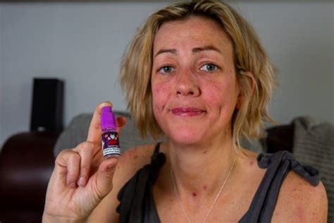 Mums Body Covered In Allergic Burns After Vaping For The First Time