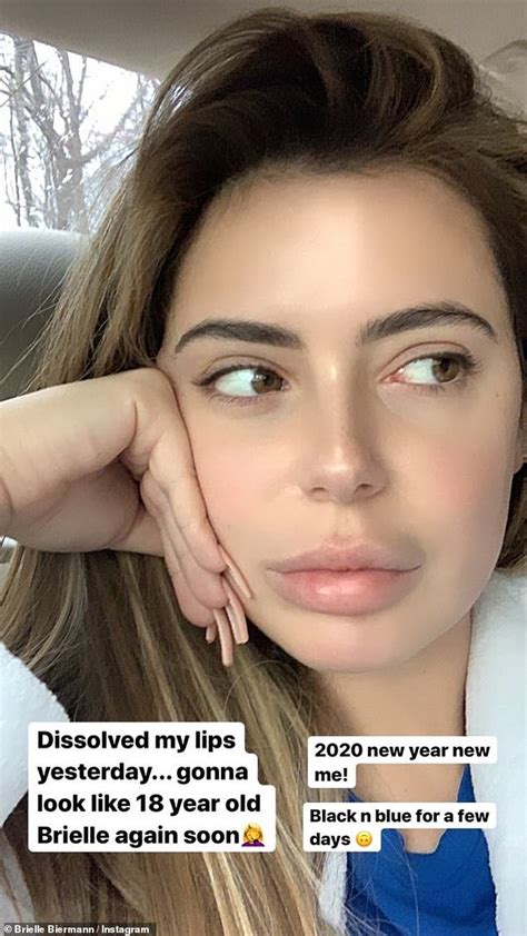 Brielle Biermann 22 Shares Selfies After Dissolving Her Lip Fillers