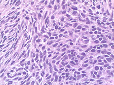 Cureus Pulmonary Spindle Cell Carcinoma A Rare Case Report