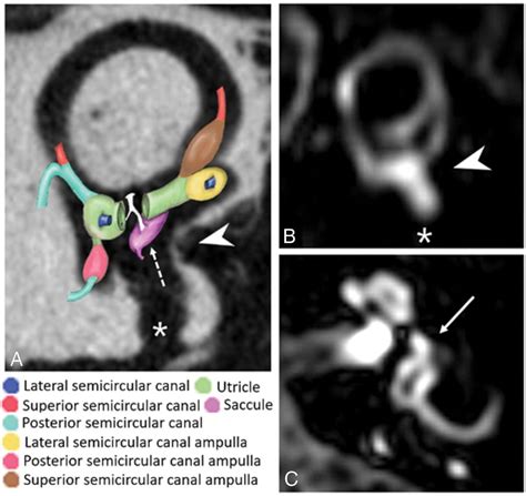 MR Imaging in Menière Disease Is the Contact between the Vestibular