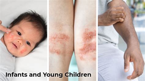 Atopic Dermatitis In Infants And Young Children Mycme