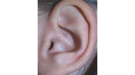 Ear Eczema Symptoms Causes Diagnosis Treatment Warning Signs