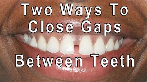 How To Close Teeth Gap Naturally At Home Grizzbye