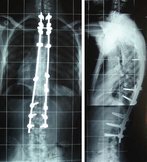 Ap And Lateral Post Operative X Rays Showing A T2l3 Posterior Spine