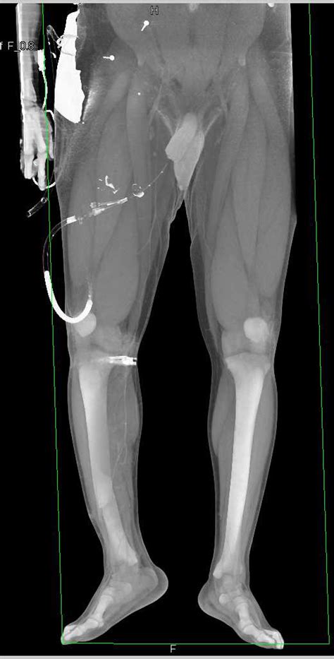 Tibia Compression Fracture Treatment Ndder