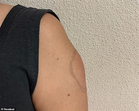 If you experience severe side effects after getting a covid vaccine, lawyers tell cnbc there is basically no one to blame in a u.s. Rare 'COVID arm' side-effect leaves people with huge ...