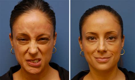 Bells Palsy Facial Exercises The Facial Paralysis Institute 2022