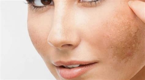 Melasma Treatment In Singapore Review On Treatment Options Edwin