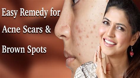 Get Rid Of Acne Scars Dark Spots With 2 Simple Ingredients Ghazal