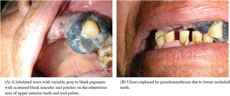 Oral Malignant Melanoma Of The Maxilla A Case Report