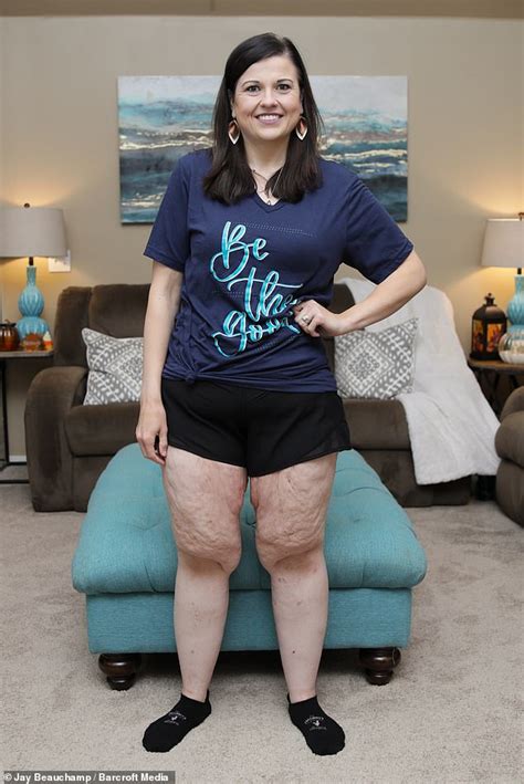 Woman Who Once Tipped Scales At 420lbs Reveals Shes Waiting To Remove 20lbs Of Excess Skin