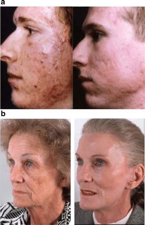 A Before And After Skin Peeling Surgery Samples 23 B Pre And Post