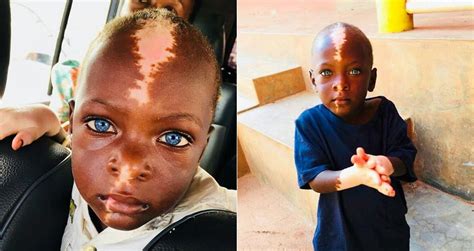 See The Little Boy Who Suffers From Vitiligo With