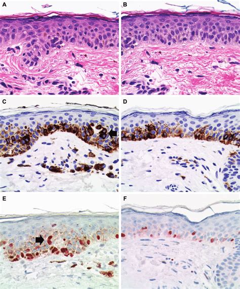 Comparison Of Melanoma In Situ Lentigo Maligna Type A And Pigmented