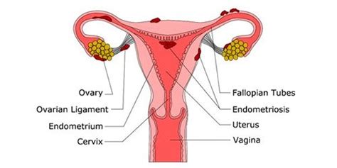 Traditional medicine for treating endometriosis. Endometriosis-Treatment | Vrinda Fertility