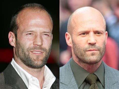 Celebrity Men Who Lost Their Hair