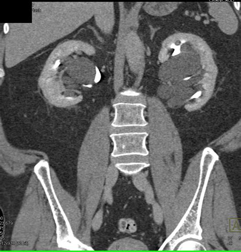Multiple Parapelvic Cysts Kidney Case Studies Ctisus Ct Scanning