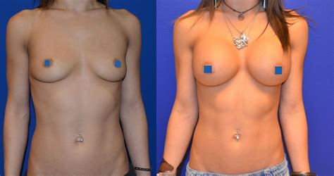 Pin On Breast Augmentation Implants Boob Job
